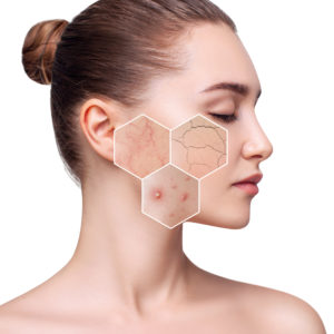 Rosacea & Redness